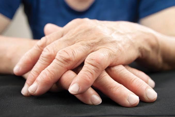 Arthritis