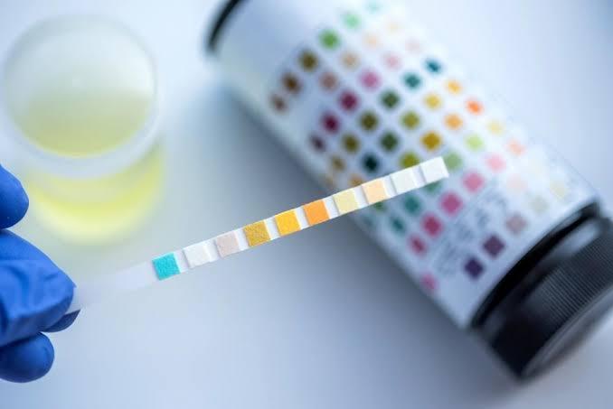 Understanding the Role of Urinalysis in Routine Health Check-ups