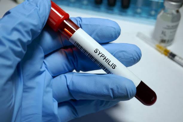 Rising Cases of Syphilis: Risks, Symptoms and Treatment