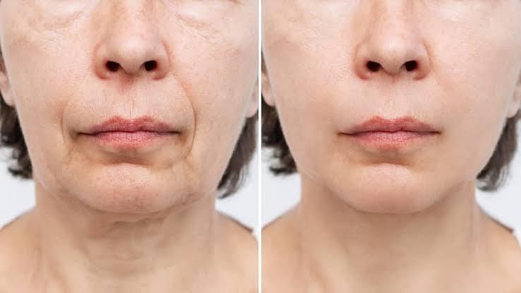 Facelifts vs Mini Facelifts: What’s Right for Your Skin and Age?