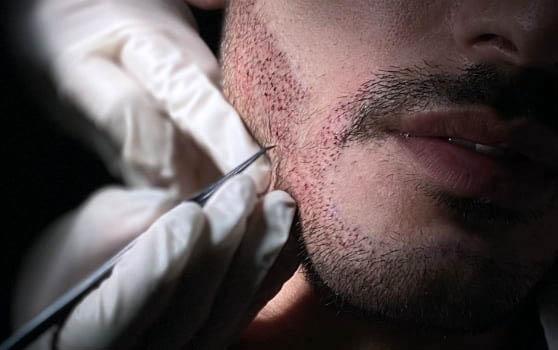 Beard Transplants Explained: The Permanent Solution to a Thicker Beard