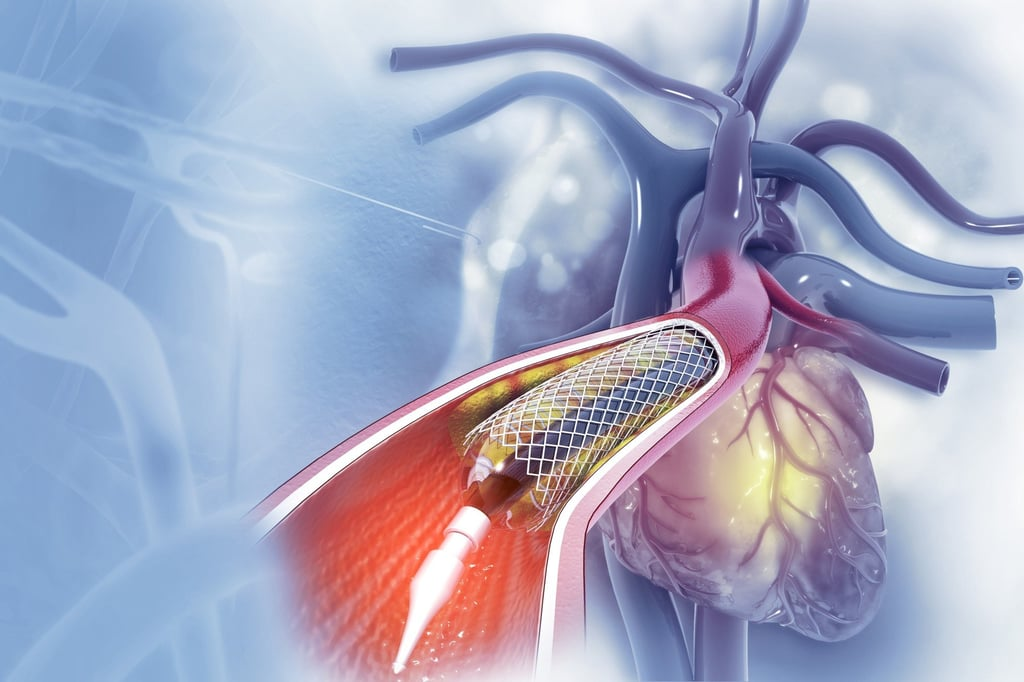 Why Medications Can’t Clear a 90% Blocked Artery and When You Need a Stent