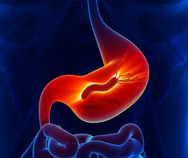 What Is H. pylori and Why Is It So Hard to Detect?